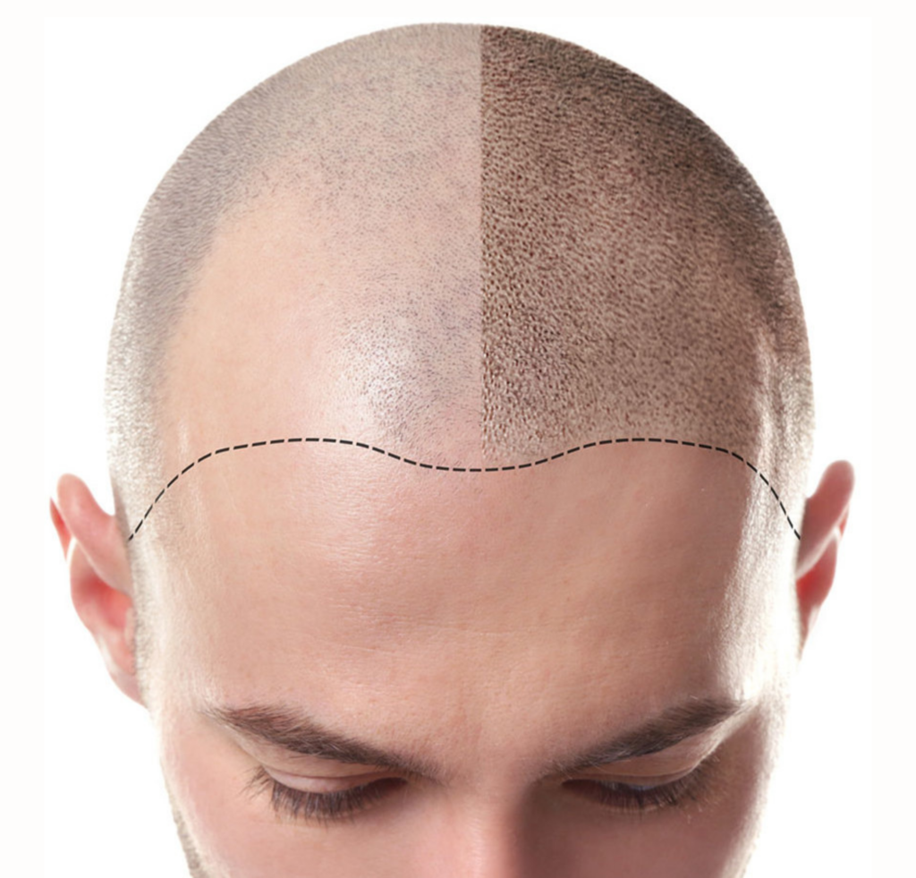 Scalp Pigmentation by Beauty mark and co